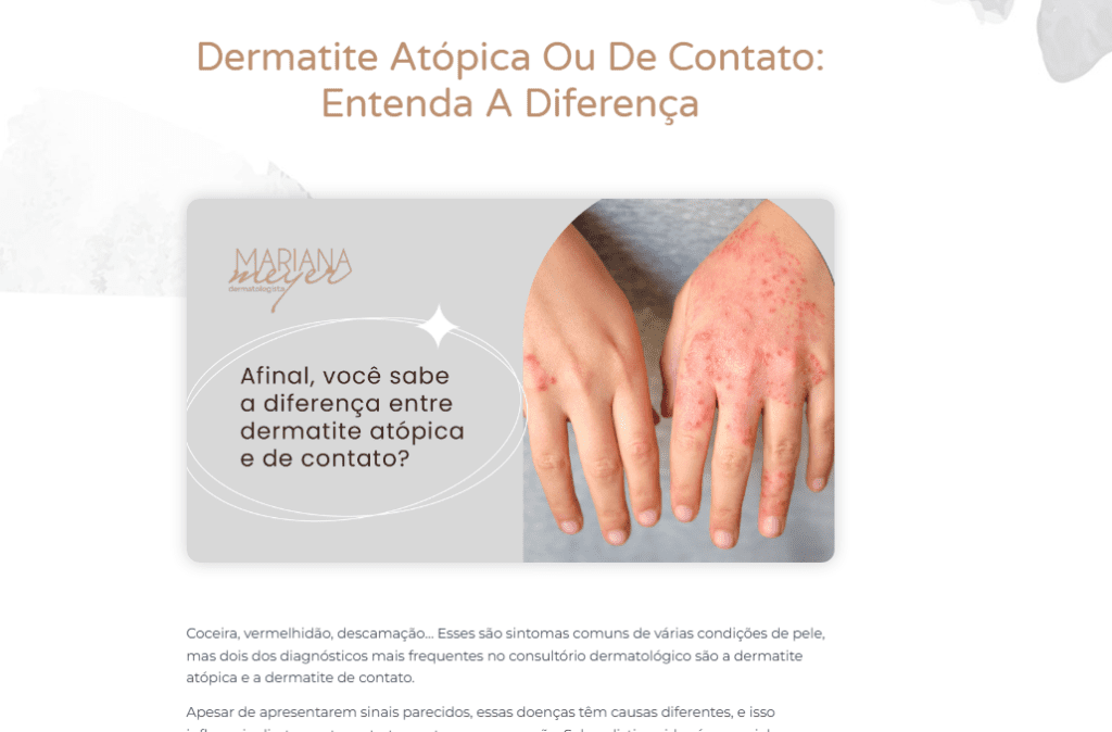 Exemplo de artigo no blog baseado em um assunto que as pessoas costumam pesquisar com bastante frequência: diferença entre os tipos de dermatite 